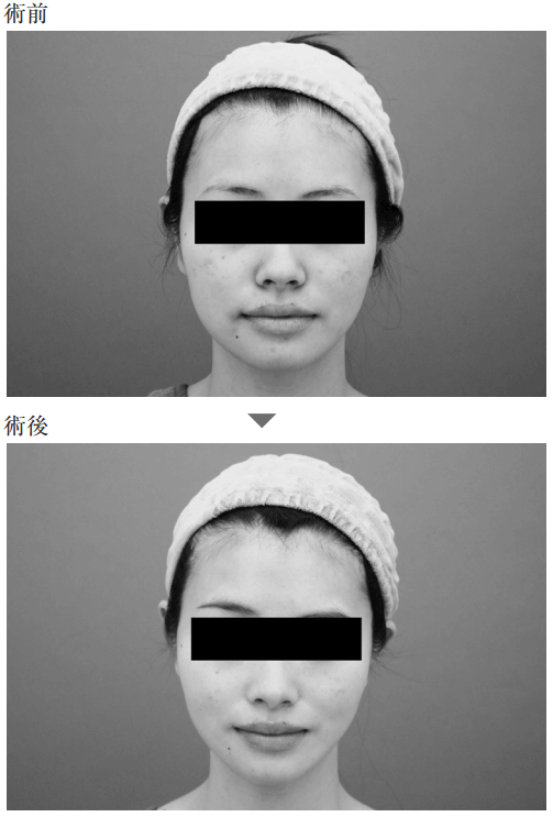 顔の脂肪吸引の事例1