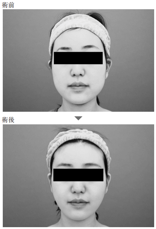 顔の脂肪吸引の事例2