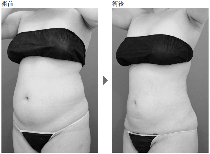 お腹の脂肪吸引の事例3