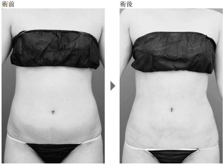 お腹の脂肪吸引の事例4