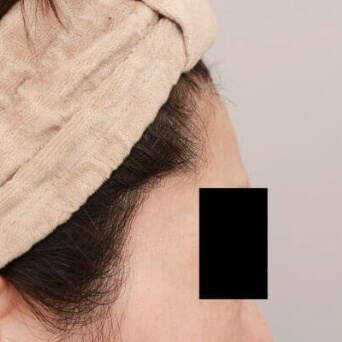 腹部全体＋腰の脂肪吸引【術前／6ヶ月後 40歳女性】の術前写真