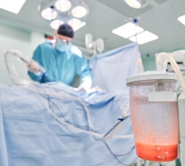 吸引量に応じた手術回数