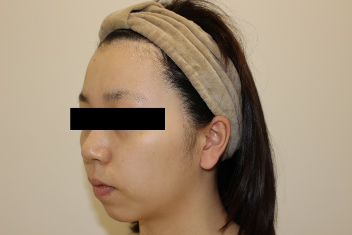 顎の形を整える　CLEVIEL（クレヴィエル）