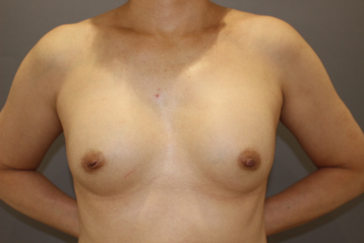 シリコンバック抜去＆コンデンスリッチ豊胸　術後４日