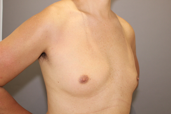 女性化乳房　術後６日目の状態