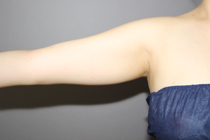 二の腕脂肪吸引 1週間経過
