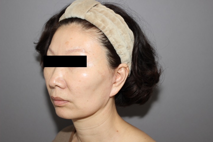 お顔への脂肪注入　　自然な若返りになります。
