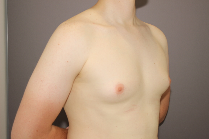 女性化乳房　４日目の経過