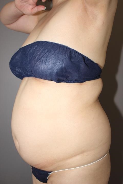 お腹・背中・脇肉の脂肪吸引 1か月半経過