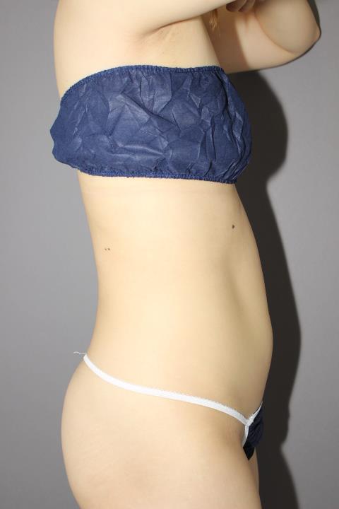 お腹・腰の脂肪吸引 1か月後