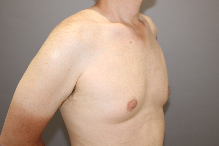 女性化乳房　　術後1か月経過