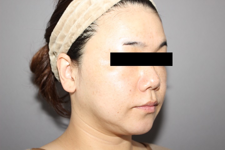 顔の脂肪吸引 2週間後