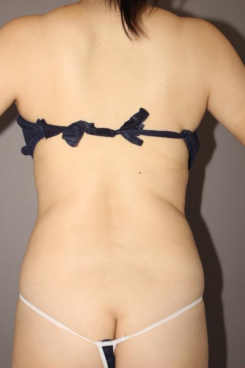 お腹・腰の脂肪吸引　１か月後