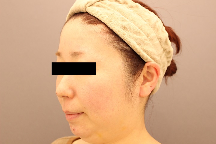 顔（頬・顎）の脂肪吸引