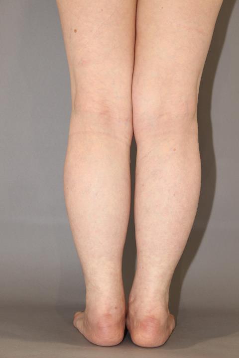 ふくらはぎ・足首　脂肪吸引　３か月経過