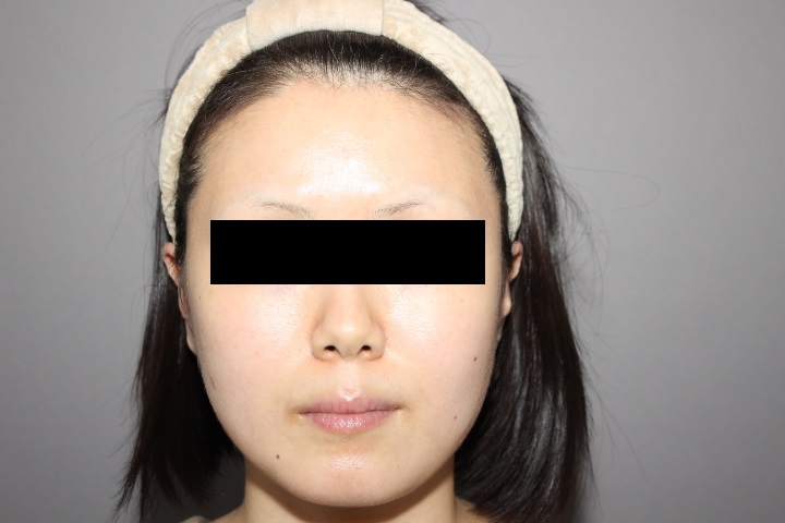 顔の脂肪吸引 3か月経過