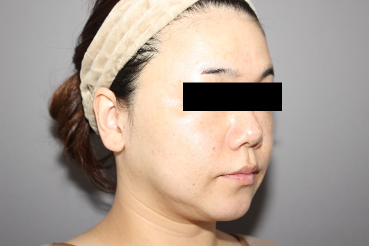 顔の脂肪吸引 3か月経過