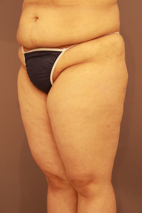 太もも全周 脂肪吸引 1週間後