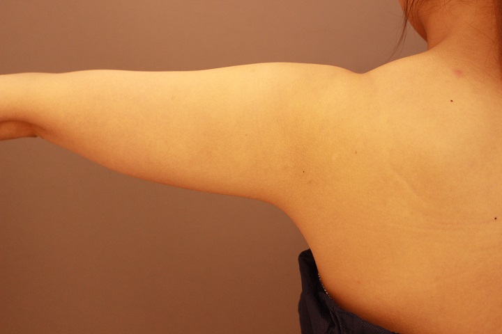 二の腕・肩　脂肪吸引　１か月後経過