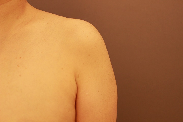 二の腕・肩　脂肪吸引　１か月後