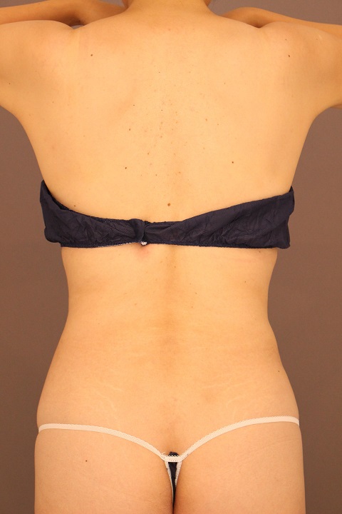 腰の脂肪吸引　３か月経過