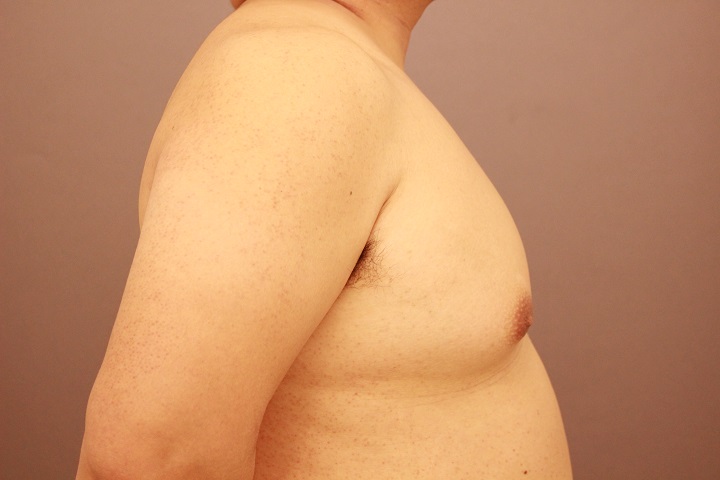 女性化乳房＆腰　1か月経過