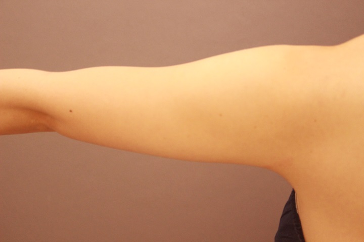 二の腕脂肪吸引　1か月経過