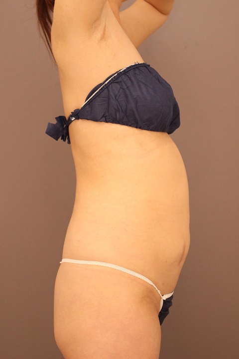 お尻のくぼみ　脂肪注入　３か月後