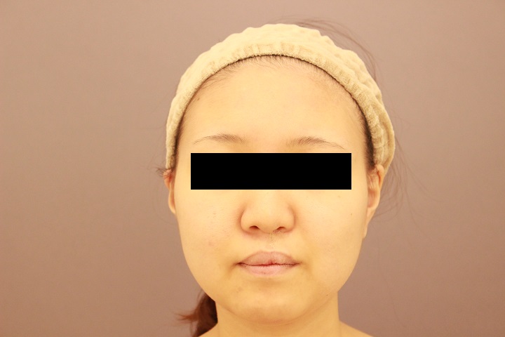 顔の脂肪吸引　３か月経過