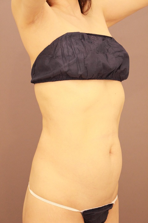 お腹・腰　脂肪吸引　３か月経過