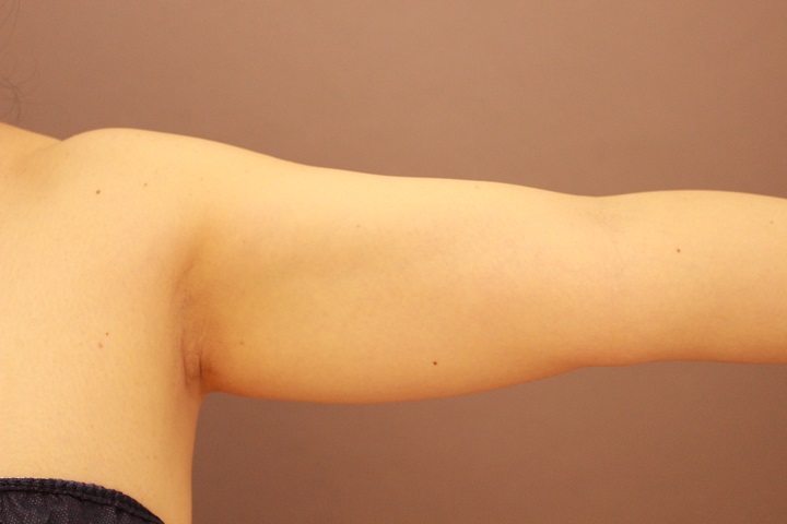 二の腕・肩　脂肪吸引　１か月経過