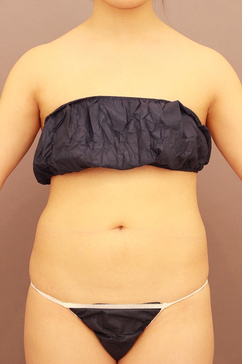 お腹・腰の脂肪吸引　翌日経過