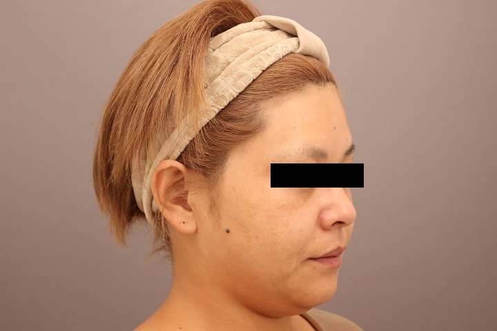 顔の脂肪吸引　半年経過