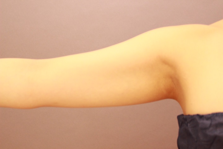 二の腕・肩　１か月経過