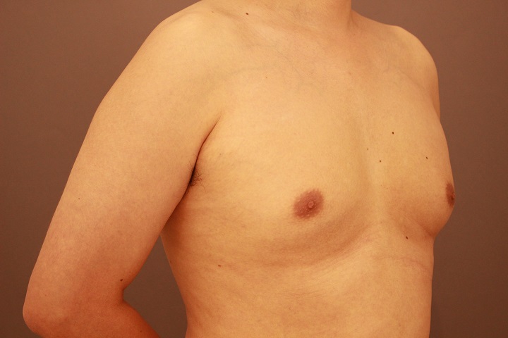 女性化乳房　１か月経過