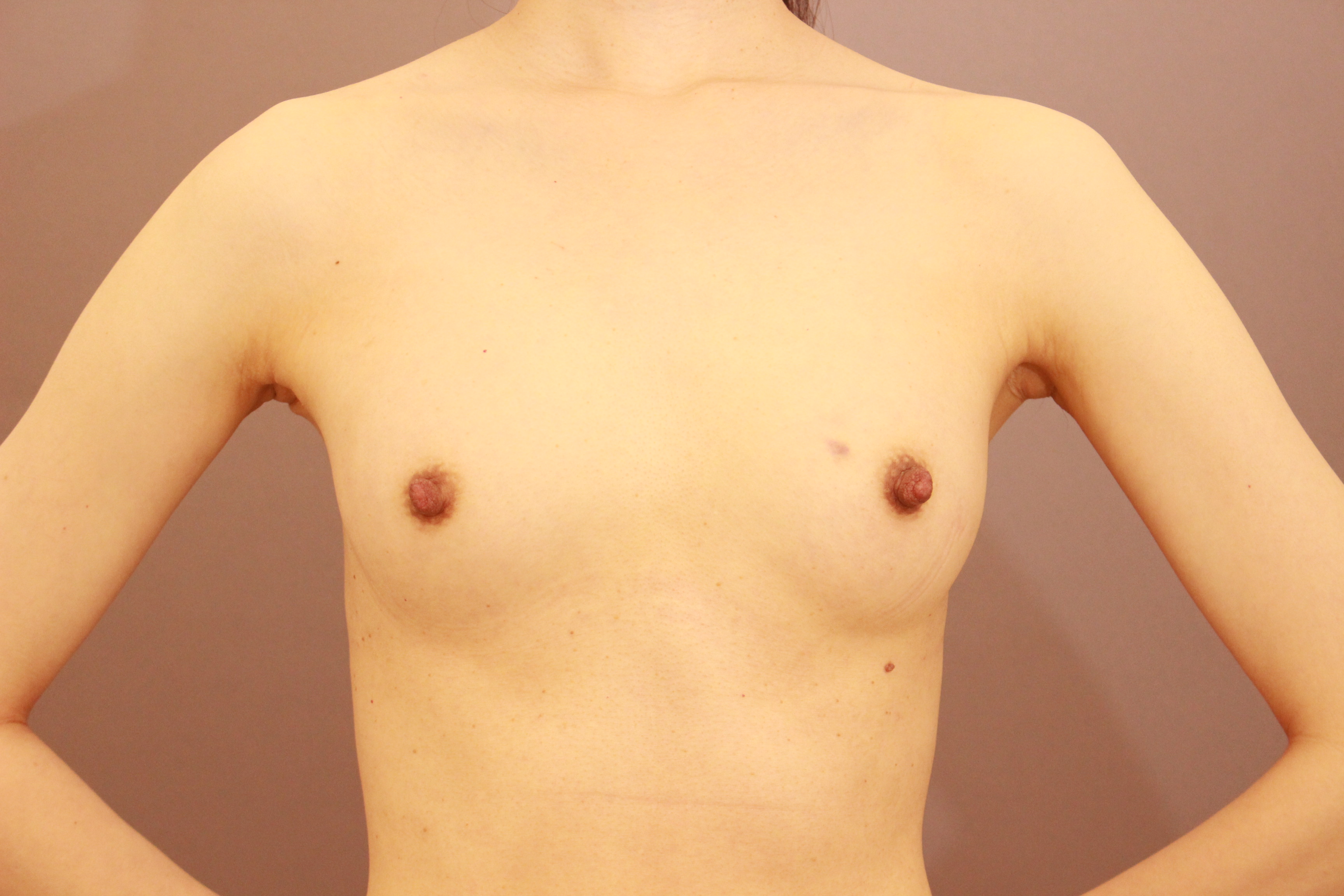 痩せていても出来ます。　　シリコンバック抜去＆コンデンスリッチ豊胸