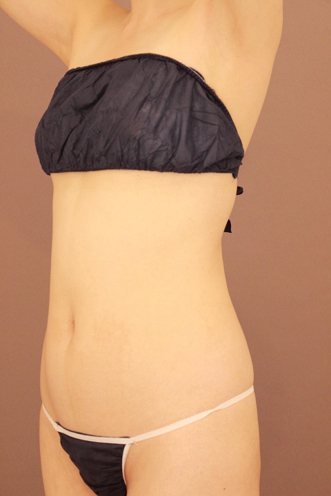 くびれを作る　脂肪吸引　半年経過