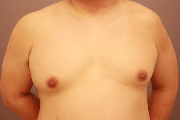 女性化乳房　術後１週間