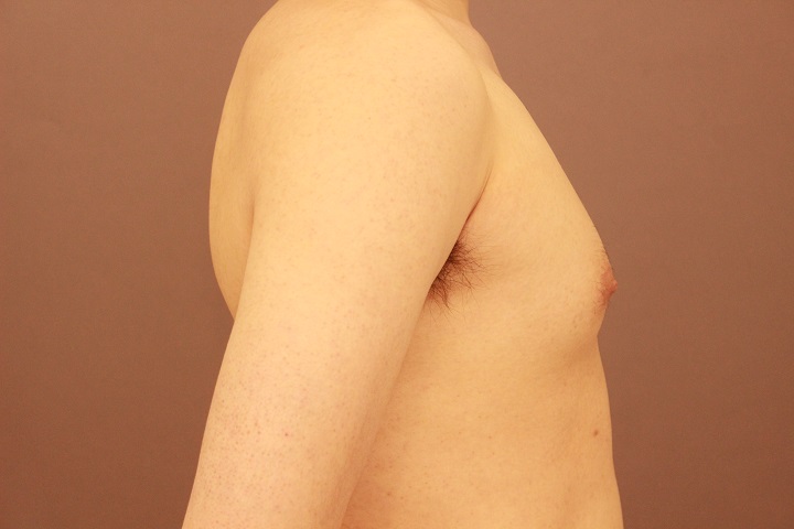 女性化乳房　１か月経過