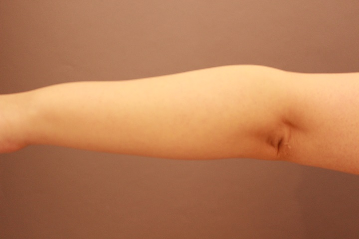 前腕の手術が増えています。