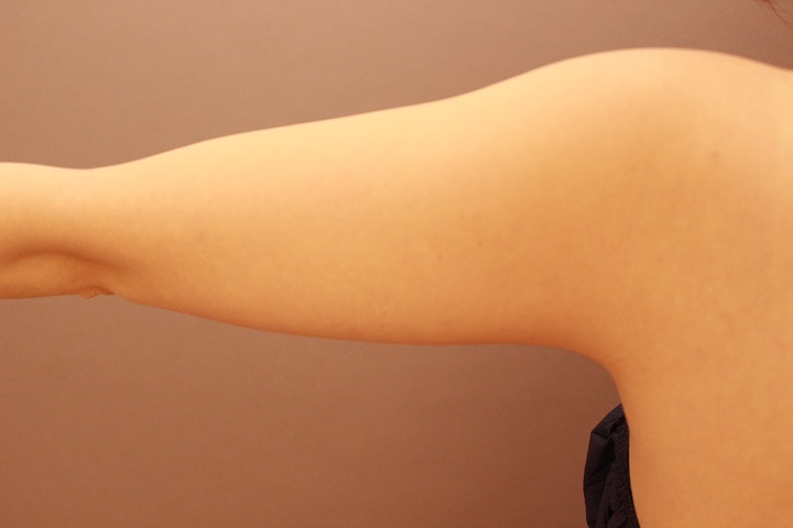 二の腕・肩　脂肪吸引　３か月経過