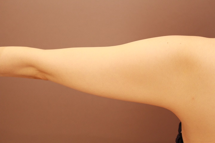 二の腕・肩 脂肪吸引 1か月経過