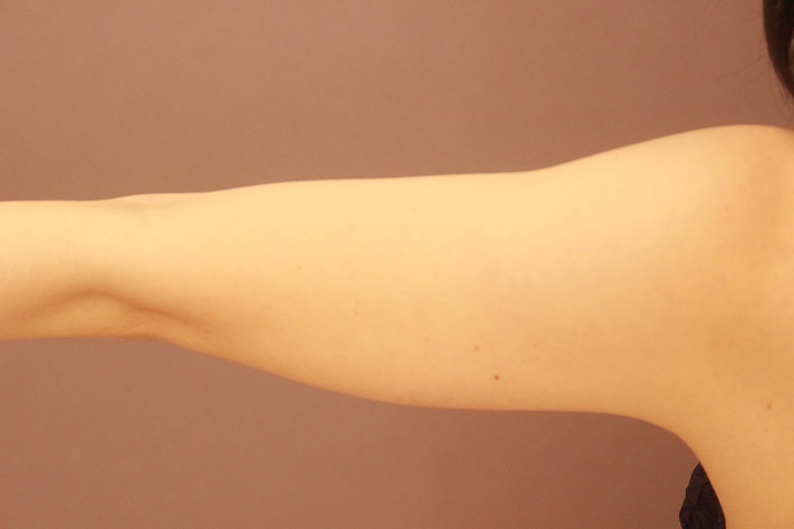 二の腕・肩 脂肪吸引 3か月経過