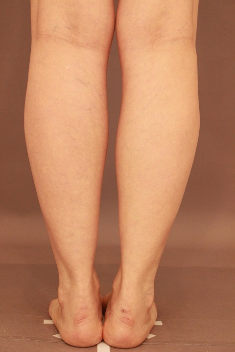 ふくらはぎ　脂肪吸引　３か月経過