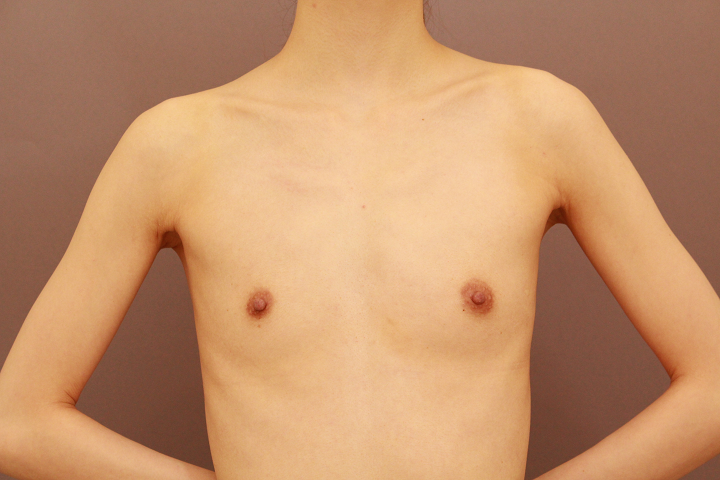 コンデンスリッチ豊胸　1か月経過