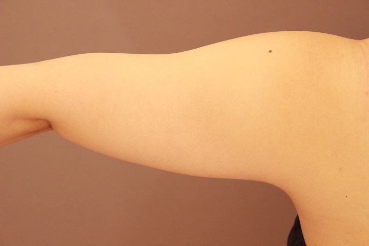 二の腕・肩 3か月経過