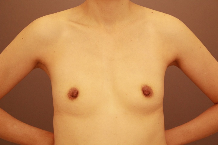 コンデンスリッチ豊胸　１か月経過