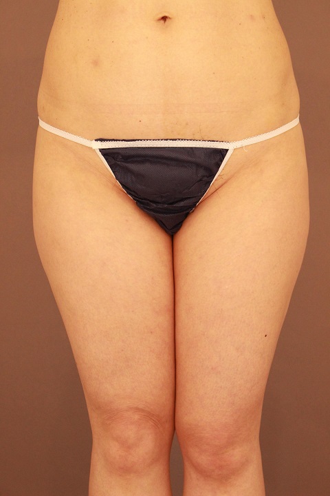 太もも　脂肪吸引　３か月経過