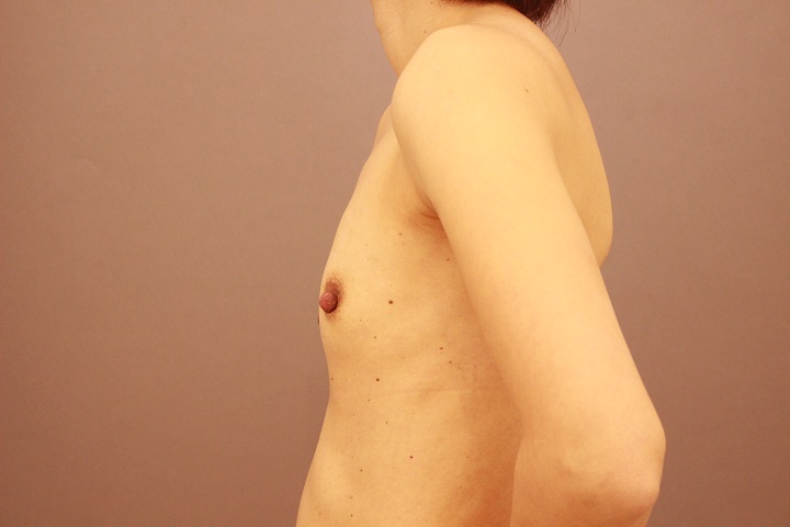 コンデンスリッチ豊胸　半年後