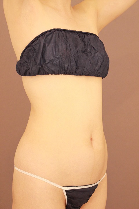 お腹の脂肪吸引　半年経過